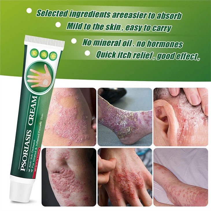 Fungal Infection Psoriasis Cream Skin Cream