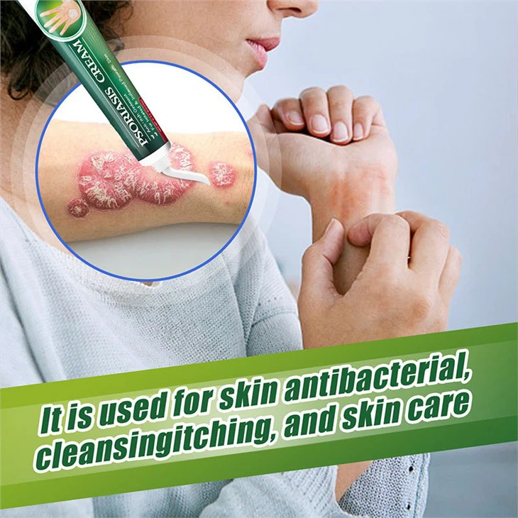 Fungal Infection Psoriasis Cream Skin Cream